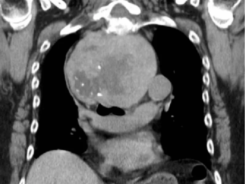 Bócio Multinodular: Quando a Cirurgia É a Melhor Saída?