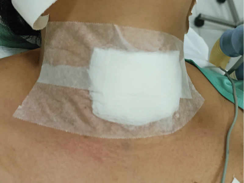 Laringoscopia Antes da Tireoidectomia: É Obrigatória? | Guia 2026