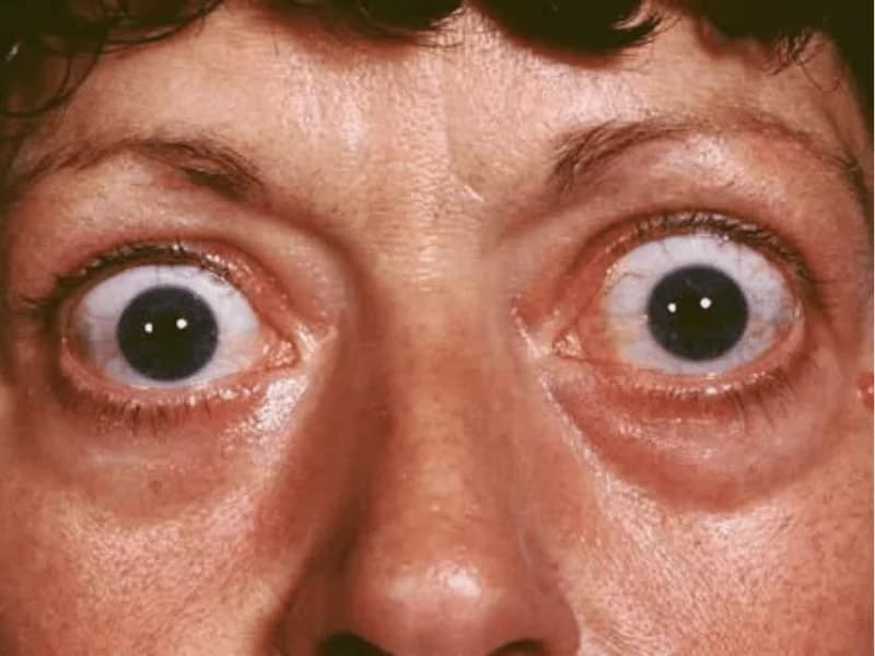 Tratamento do Hipertireoidismo: Medicamento, Radioiodo ou Cirurgia | 2026