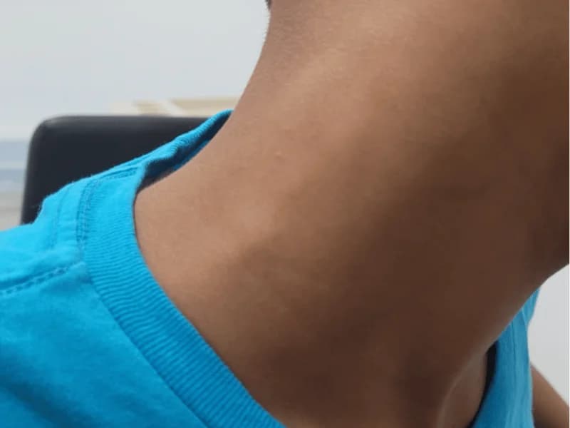 Linfonodo Aumentado no Pescoço: Quando se Preocupar? | Guia 2026