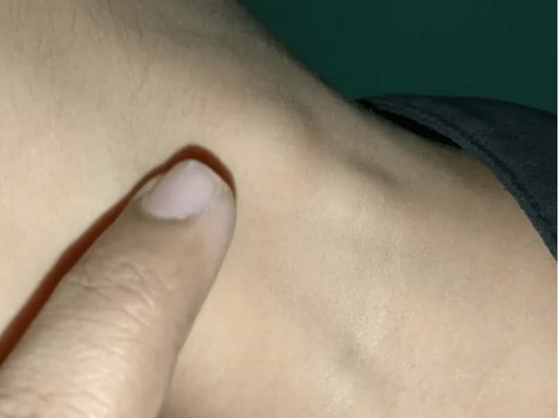 Linfonodo Reacional: O Que Significa no Laudo do Ultrassom | Guia 2026