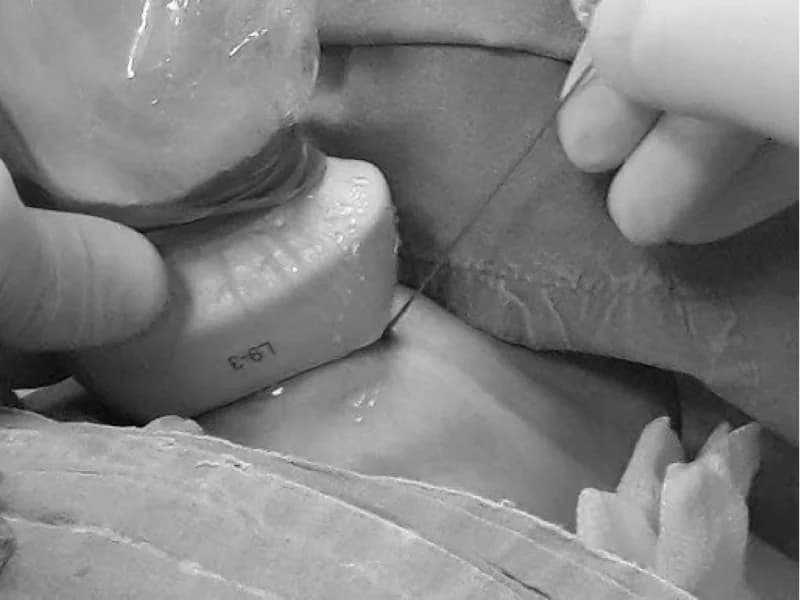 Punção da Tireoide (PAAF): Como é Feito, Dói? Anestesia? | Guia 2026