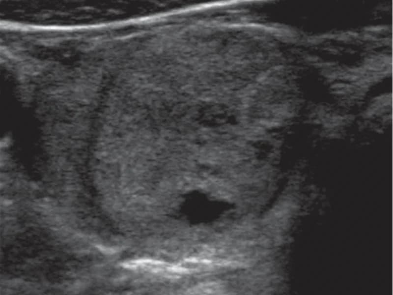 Nódulo Bethesda II na Tireoide: Acompanhar ou Operar?