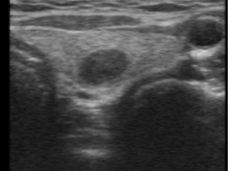 Nódulo na Tireoide: Quando É Hora de Operar? Critérios 2026