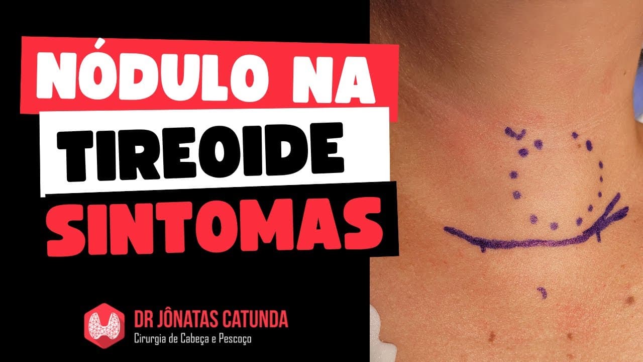 Sintomas dos nódulos na tireoide - Ao vivo respondendo perguntas