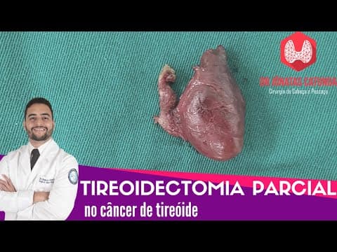 Tireoidectomia parcial X Câncer de tireóide: Indicações, seguimento, tireoglobulina