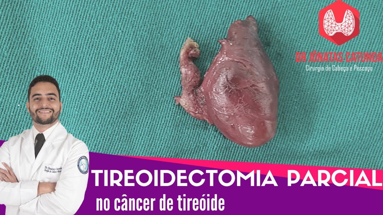 Tireoidectomia parcial X Câncer de tireóide: Indicações, seguimento, tireoglobulina