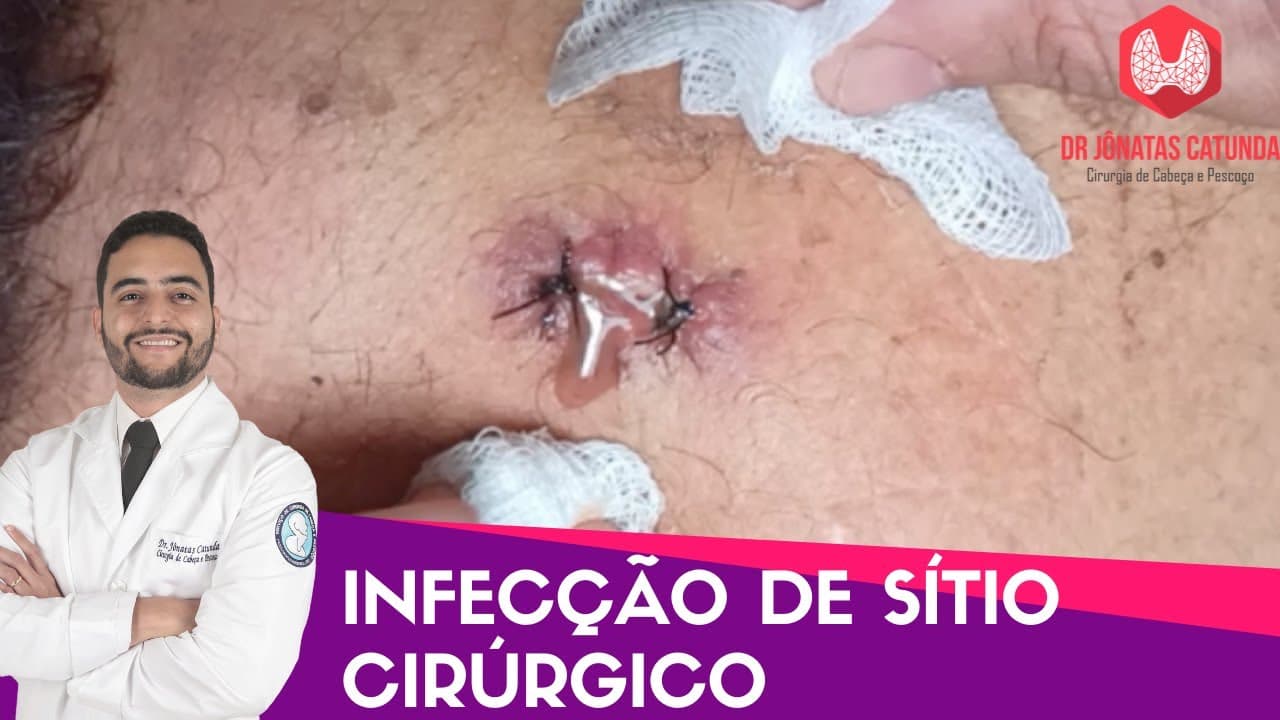 Infecção de cirurgia - Caso clínico