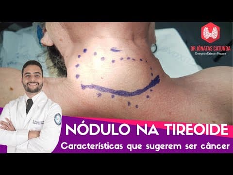Nódulo na tireoide - características que sugerem ser câncer - Live Tudo Sobre Tireóide