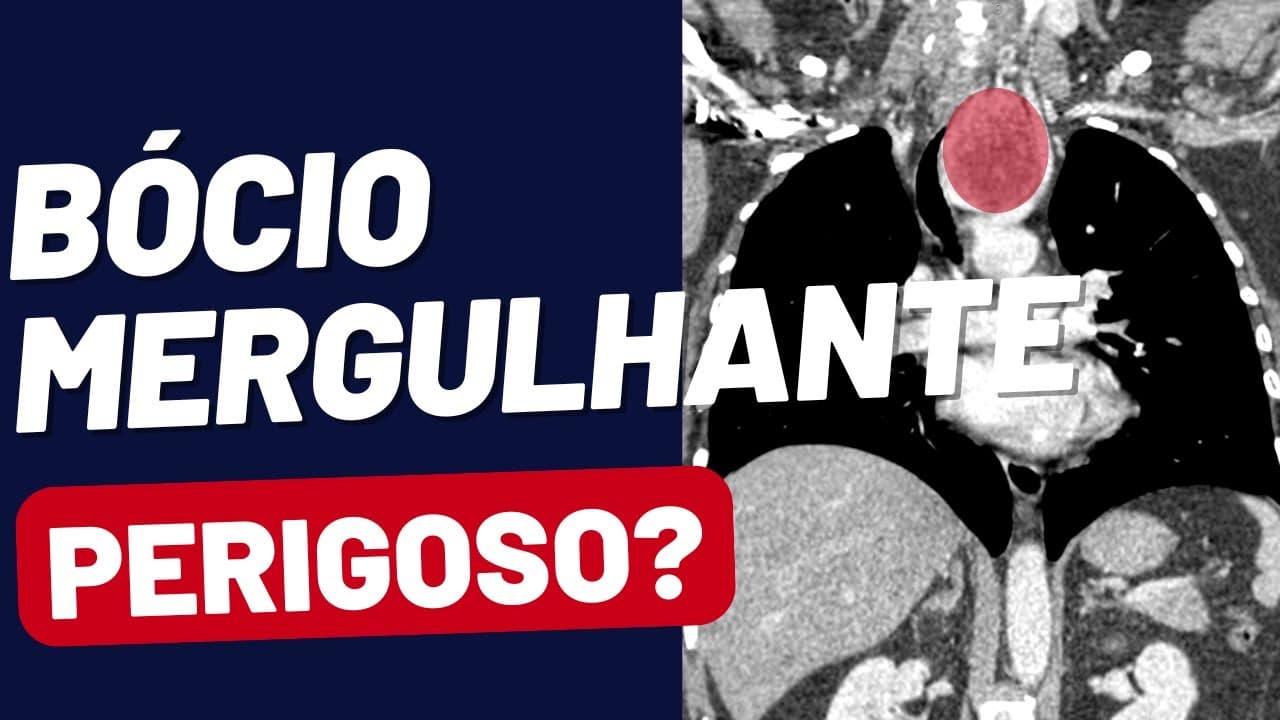 Bócio mergulhante: como identificar e quando operar