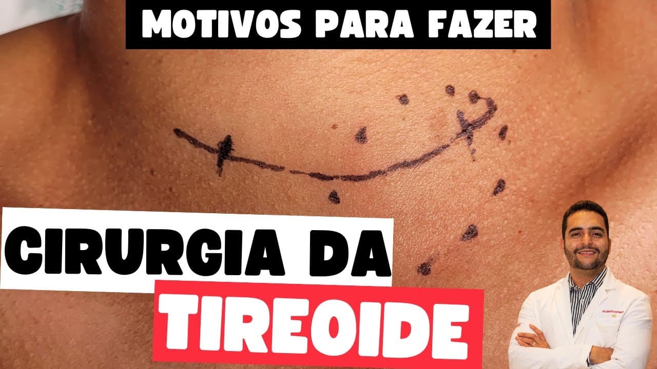 Quando o nódulo na tireoide precisa de cirurgia: entenda os critérios e riscos