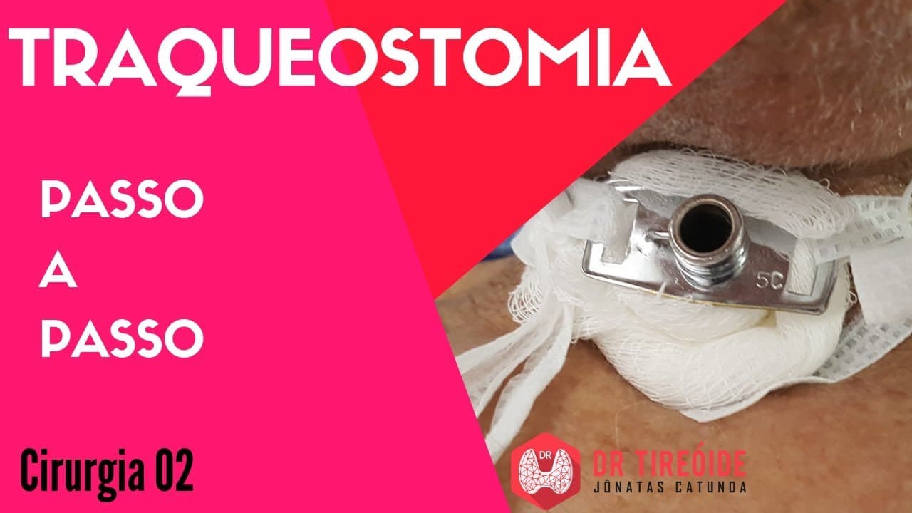Traqueostomia - Cirurgia Passo a passo | Dr Jônatas Catunda