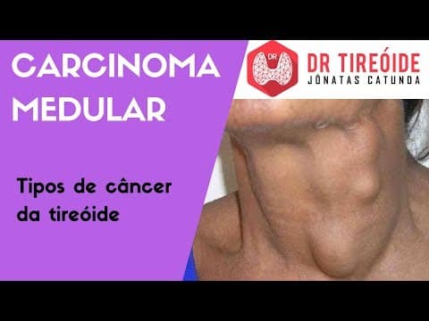 Carcinoma Medular - Tipos de câncer de tireóide | Dr Jônatas Catunda