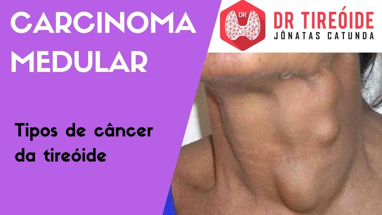 Carcinoma Medular - Tipos de câncer de tireóide | Dr Jônatas Catunda