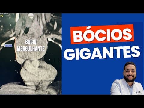 Minha experiência com bócios gigantes