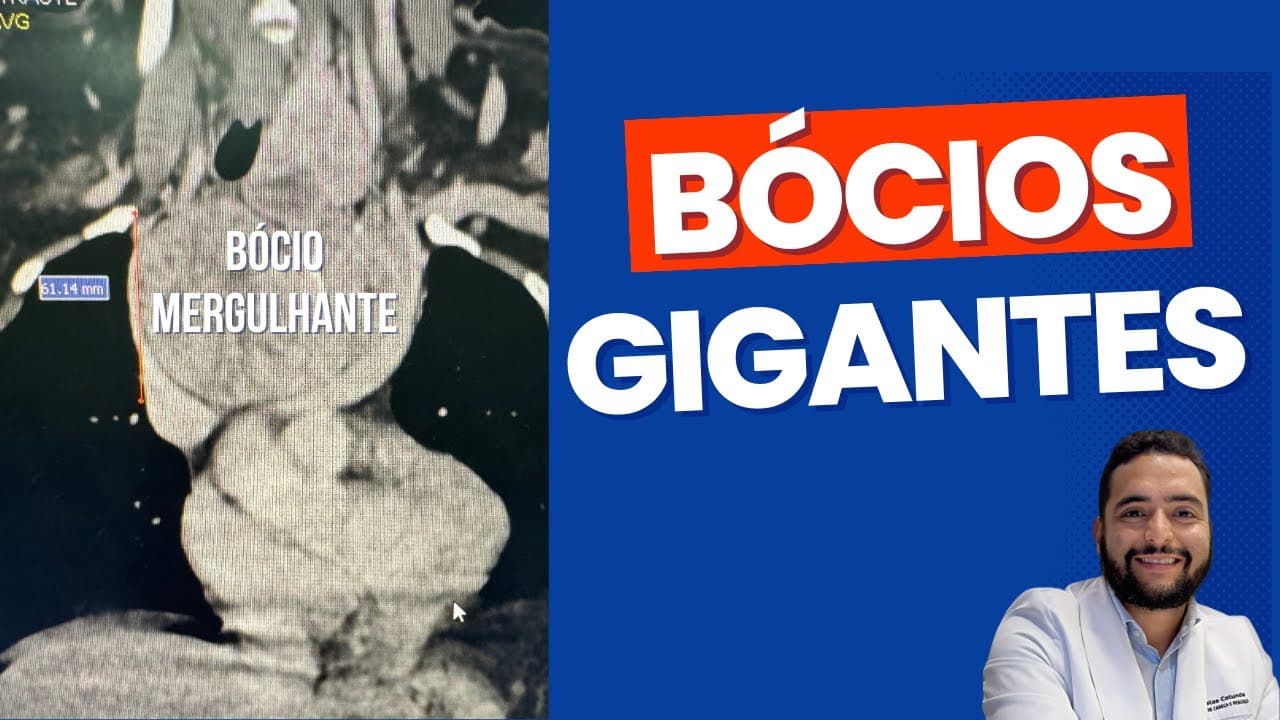 Minha experiência com bócios gigantes