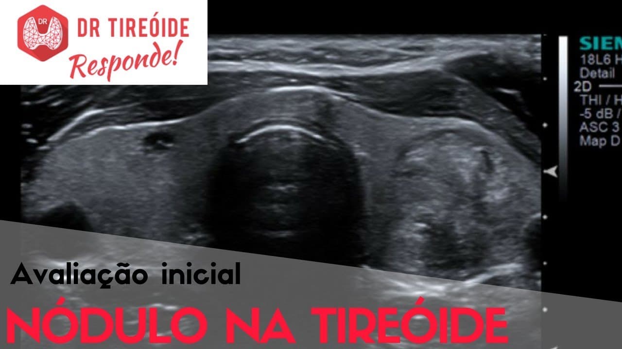 Avaliação inicial do nódulo na tireóide - Dr Tireóide Responde
