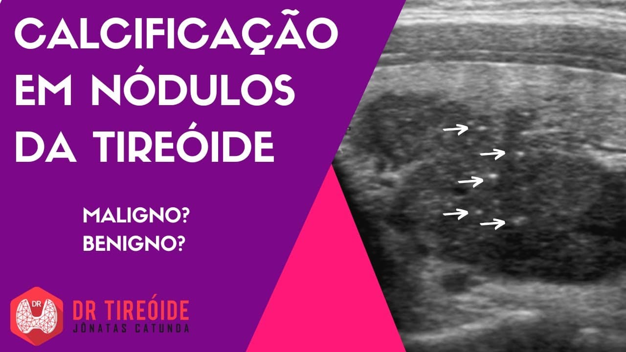 Calcificação em nódulos da tireóide - Microcalcificações? Macrocalcificações?