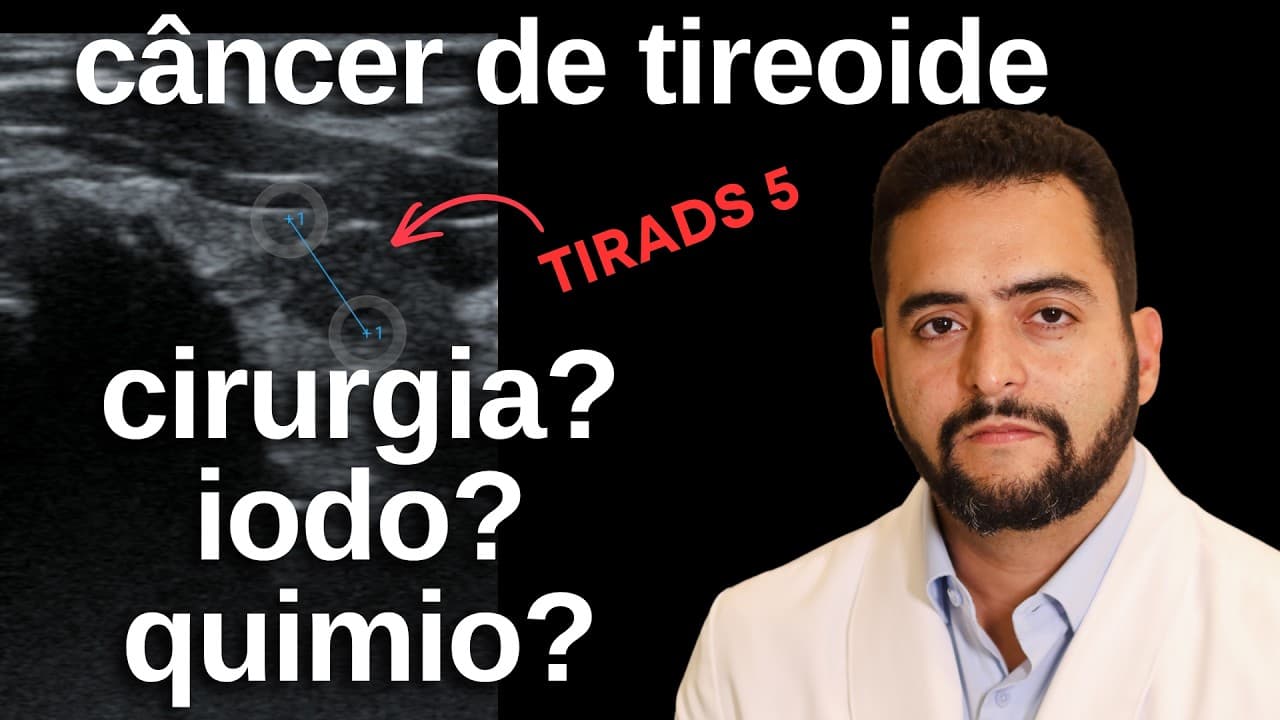 Câncer de Tireoide: vou precisar de cirurgia, iodo ou quimioterapia?