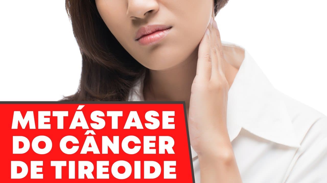 Como avaliar uma possível metástase do câncer de tireoide - Ultrassom, punção, tireoglobulina