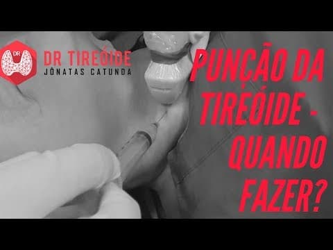 Punção da tireóide - PAAF - Quem precisa fazer esse exame? | Dr Jônatas Catunda