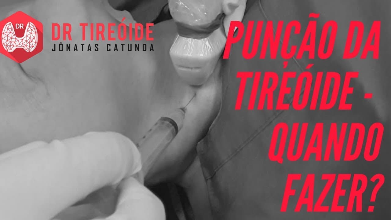 Punção da tireóide - PAAF - Quem precisa fazer esse exame? | Dr Jônatas Catunda