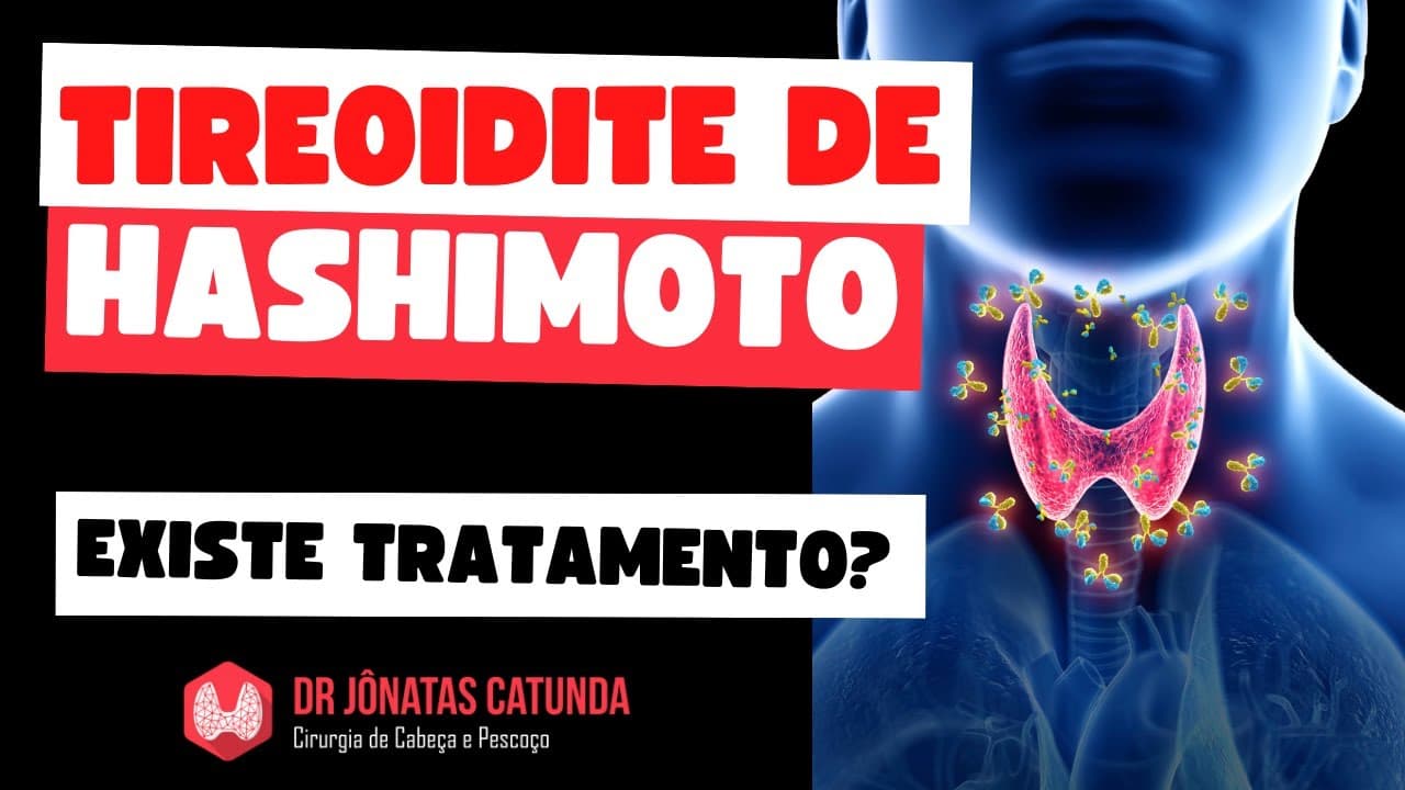 Existe tratamento para tireoidite de Hashimoto?