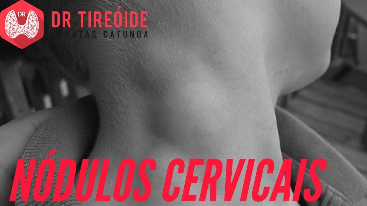 Nódulos cervicais - Saiba o que pode ser! | Dr Jônatas Catunda