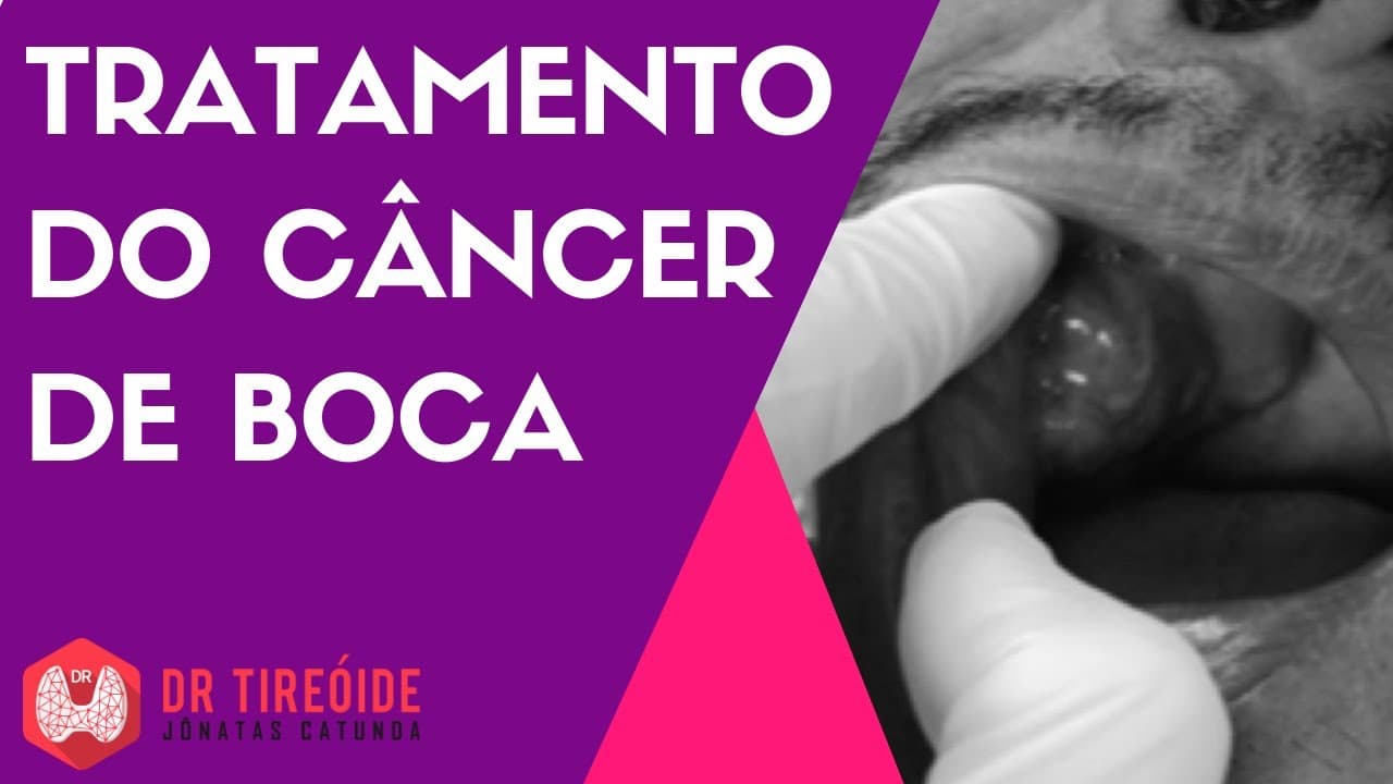 Tratamento do câncer de boca - Dr Jônatas Catunda
