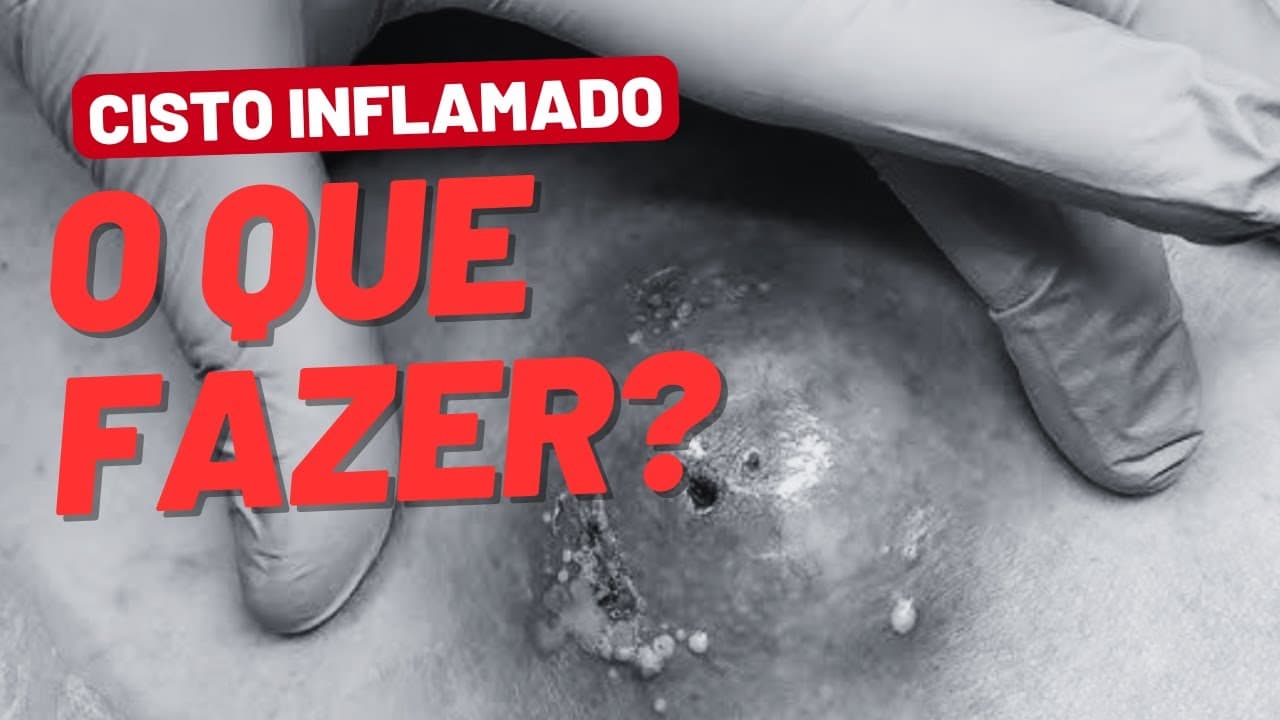 Cisto inflamado e dolorido: o que fazer agora