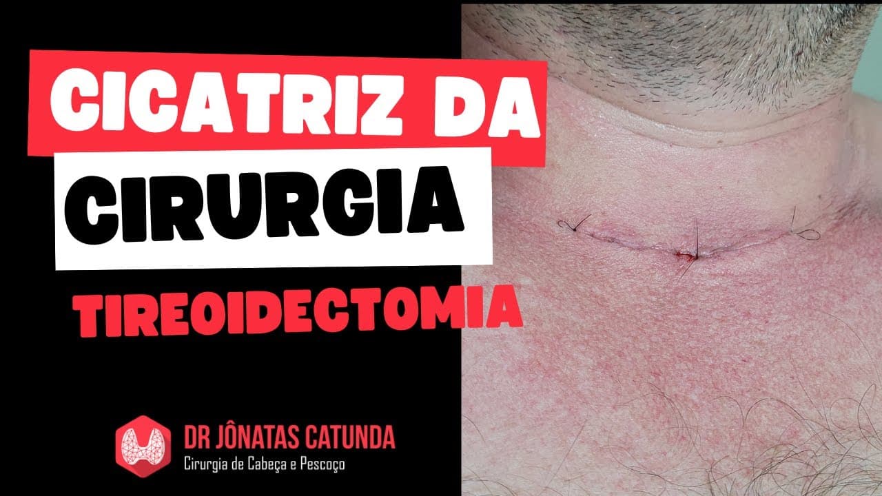 Cicatriz da cirurgia da tireóide - tireoidectomia total / tireoidectomia parcial
