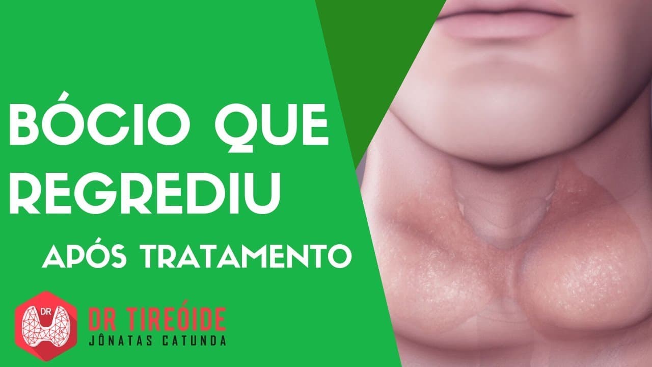 Bócio que regrediu após tratamento do hipotireoidismo - Caso Clínico Dr Jônatas Catunda