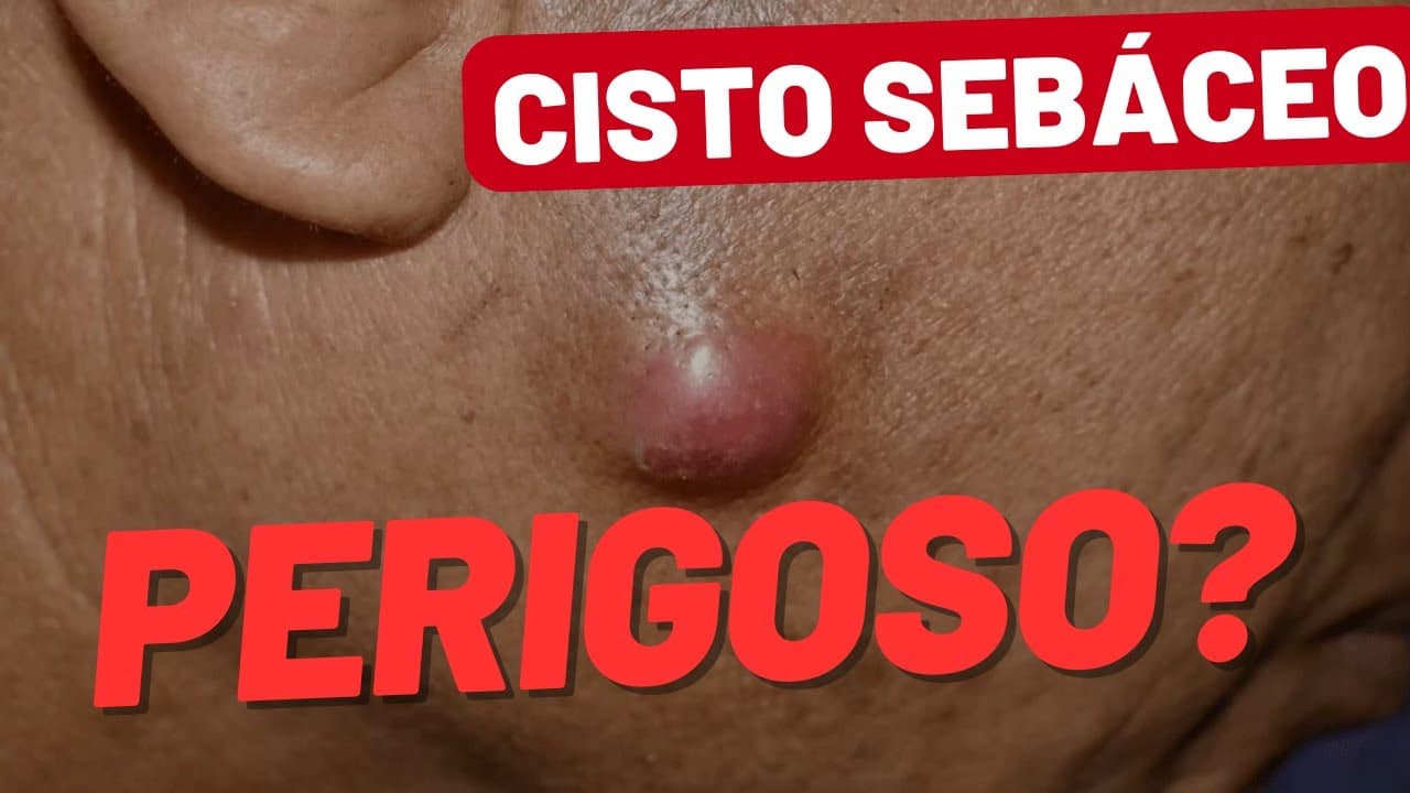 Cisto sebáceo é perigoso? Os sinais de alerta