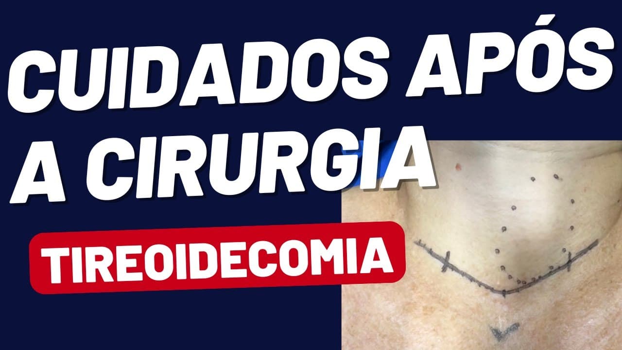Cirurgia de Tireoide: Os Principais Cuidados para uma Recuperação Segura