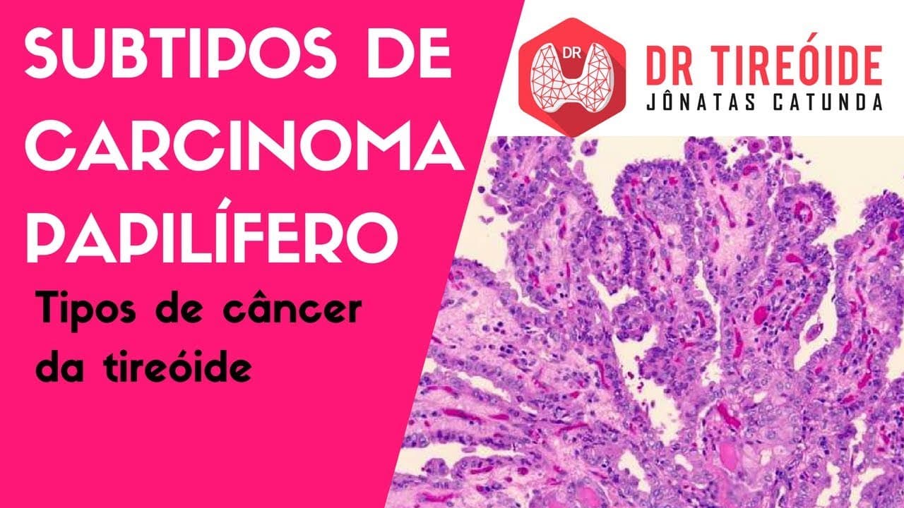Subtipos do Carcinoma Papilífero - Variante folicular? Variante células altas? | Dr Jônatas Catunda