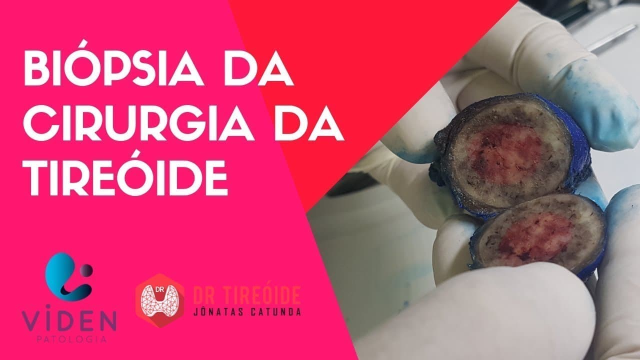 Como é feita a biópsia da cirurgia da tireóide?