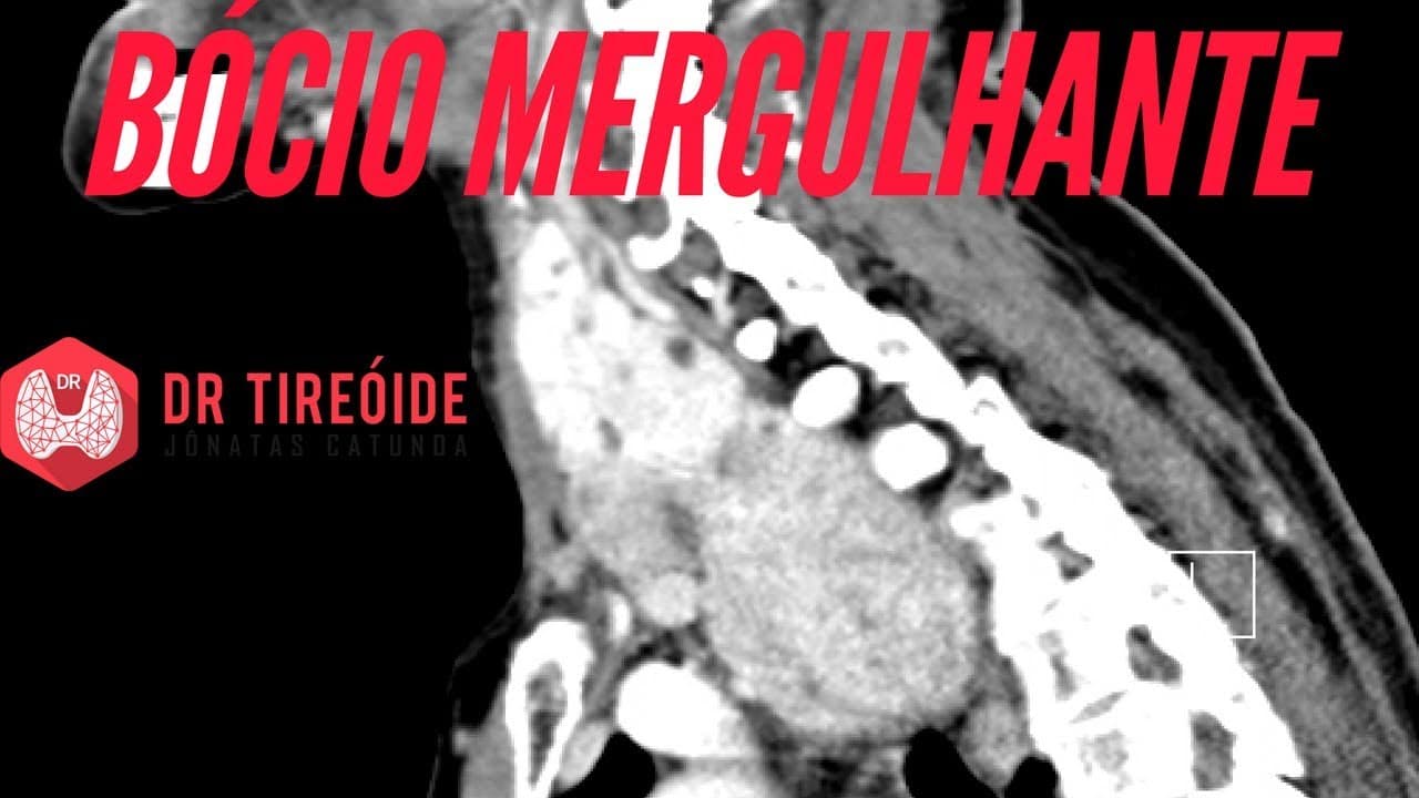 Bócio Mergulhante - Quando a tireóide cresce demais! | Dr Jônatas Catunda