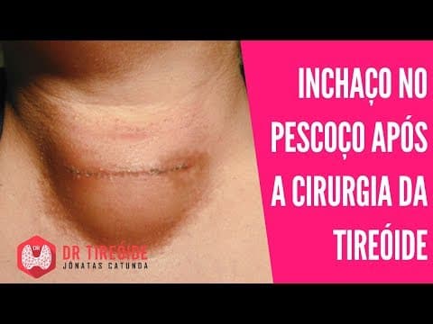 Edema no pescoço após a cirurgia da tireóide | Dr Jônatas Catunda