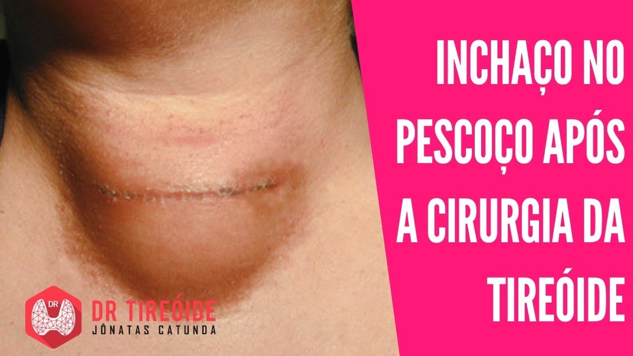 Edema no pescoço após a cirurgia da tireóide | Dr Jônatas Catunda