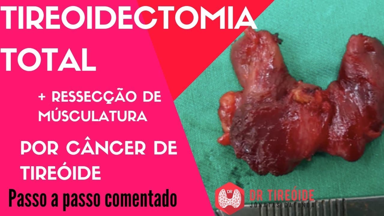 Tireoidectomia total por câncer de tireóide - Cirurgia Passo a passo | Dr Jônatas Catunda