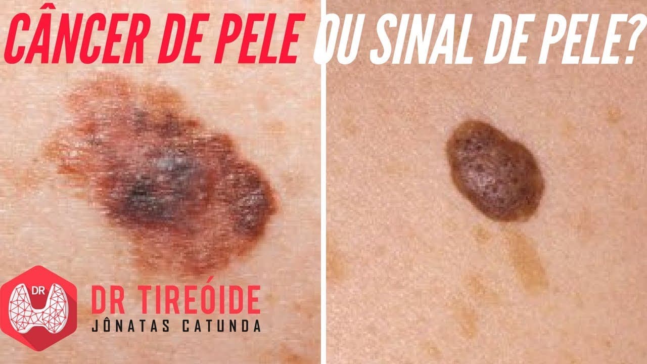 Sinais do Câncer de Pele - Melanoma X Sinal de pele | Dr Jônatas Catunda