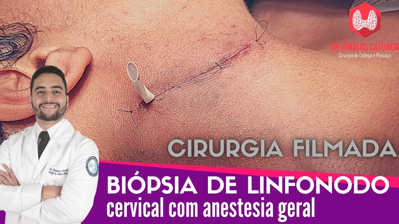 Biopsia de linfonodo no pescoço com anestesia geral