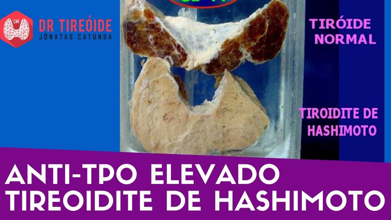 Anti-TPO elevado - Tireoidite de Hashimoto? - Dr Tireóide responde