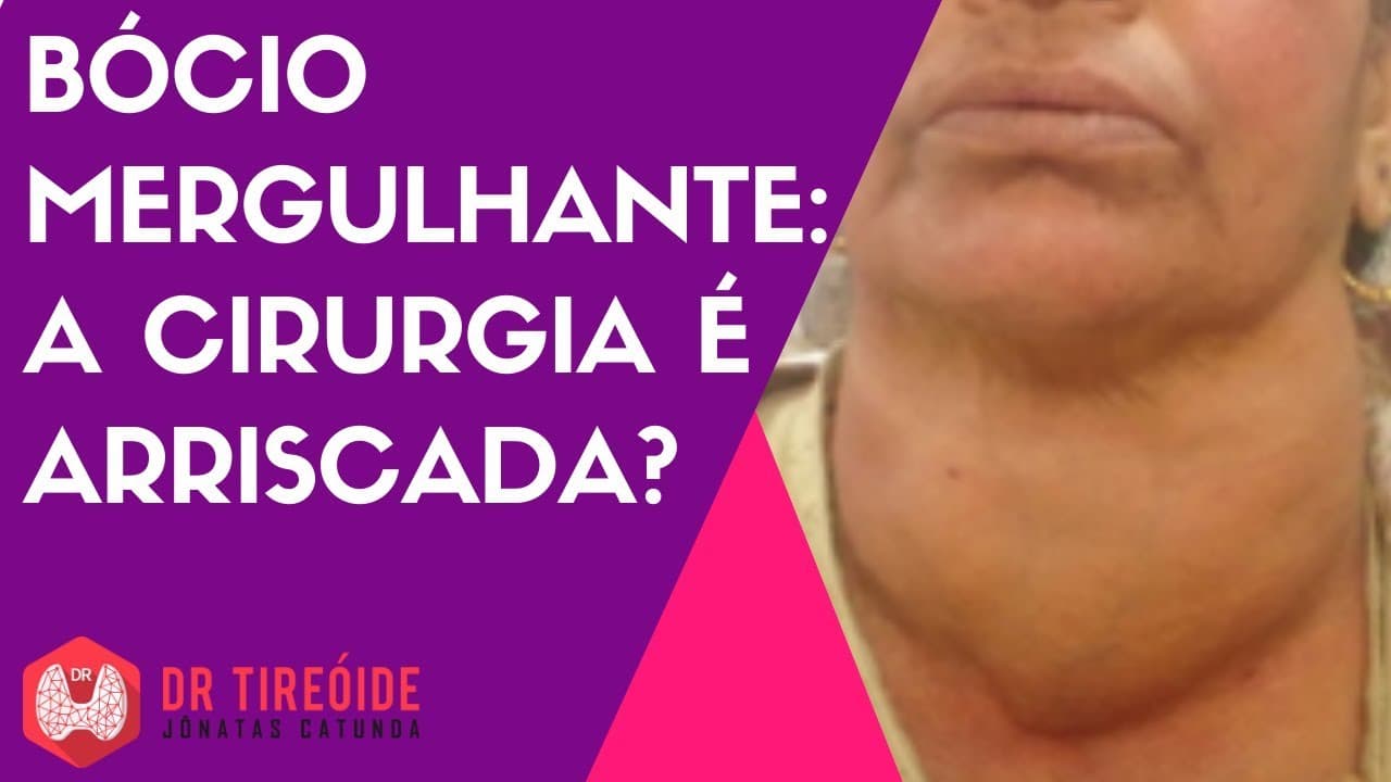 Bócio mergulhante - a cirurgia é arriscada?