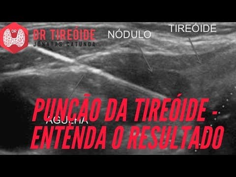 PAAF da Tireóide - Entenda o resultado e o Bethesda! | Dr Jônatas Catunda