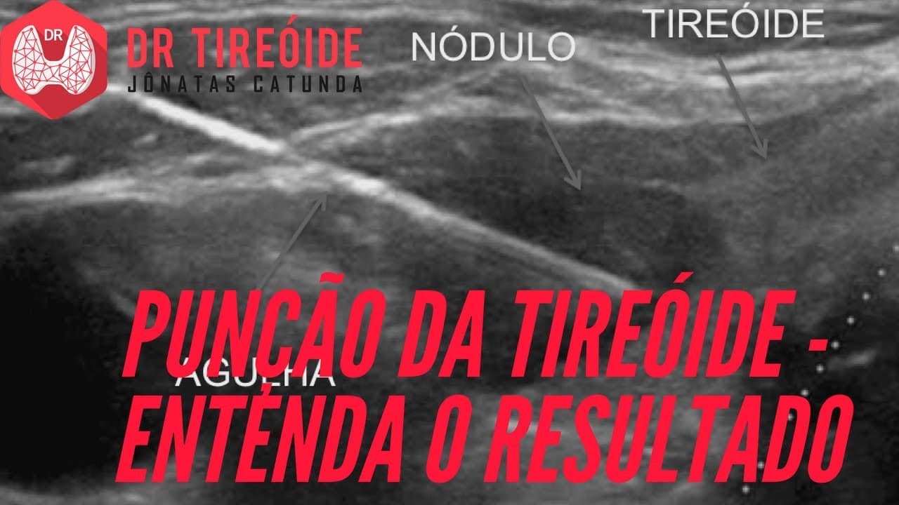 PAAF da Tireóide - Entenda o resultado e o Bethesda! | Dr Jônatas Catunda
