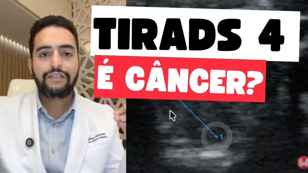 TIRADS 4 na Tireoide — Precisa Operar? Risco Real de Câncer? | Dr. Jônatas Catunda