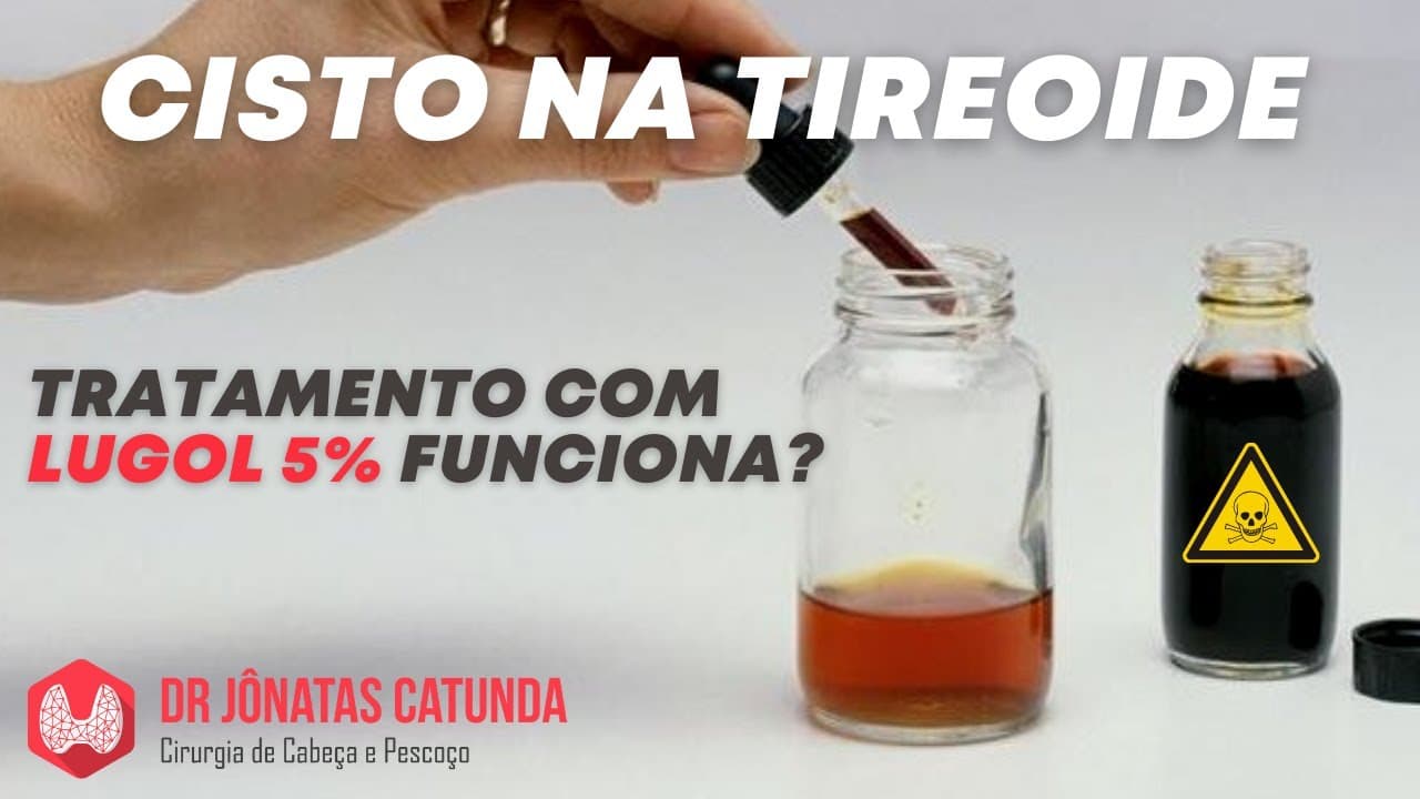 Lugol 5% para tratar cisto na tireóide: coisa do passado