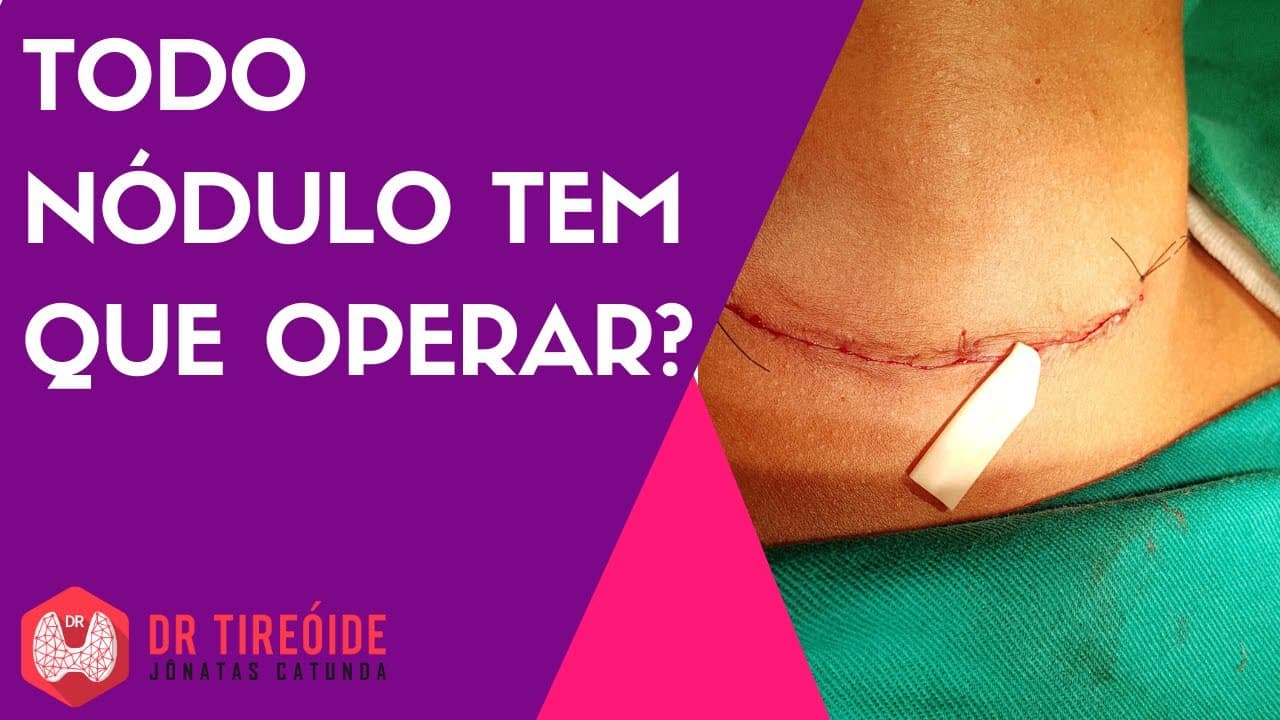 Todo nódulo da tireóide tem que operar?