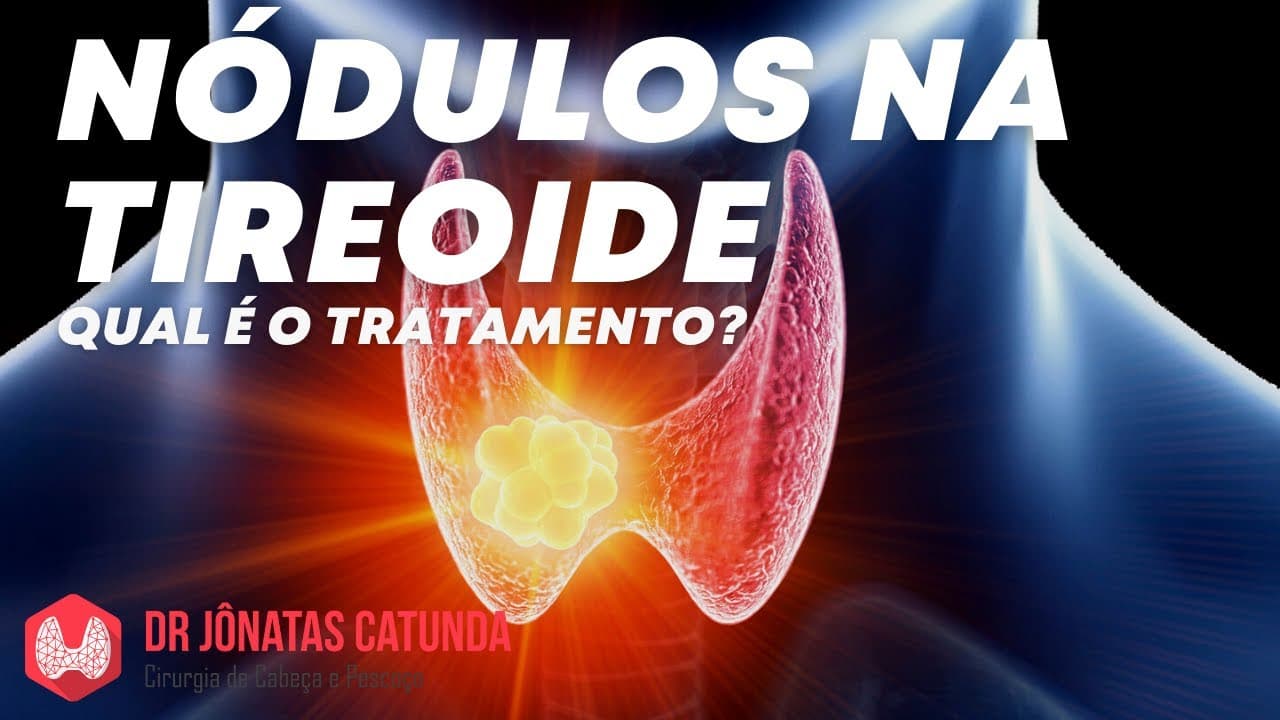 Nódulo na tireoide: existe medicamento para fazer o nódulo regredir?